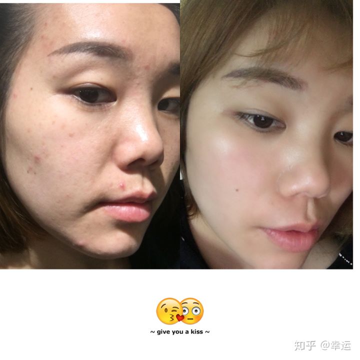 脸上有痘能不能用冻干粉 脸上有痘能不能用冻干粉呢