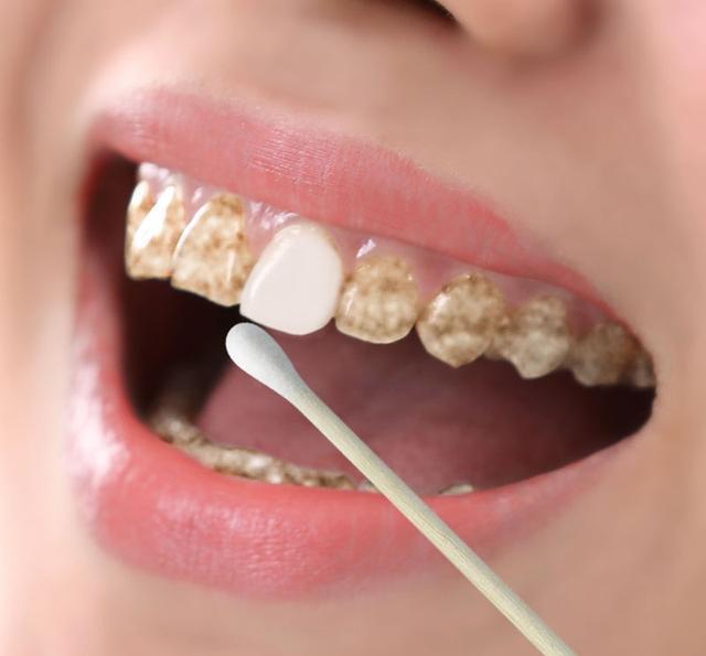牙一半白一半黄为什么 牙齿一半是白的一半是黄的