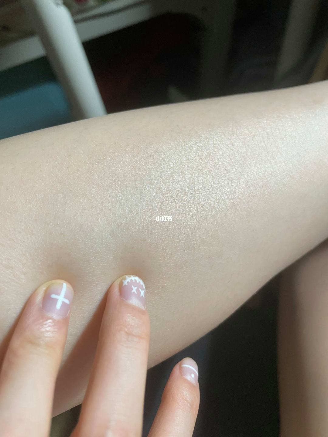 冰点脱毛后 冰点脱毛后长小疙瘩